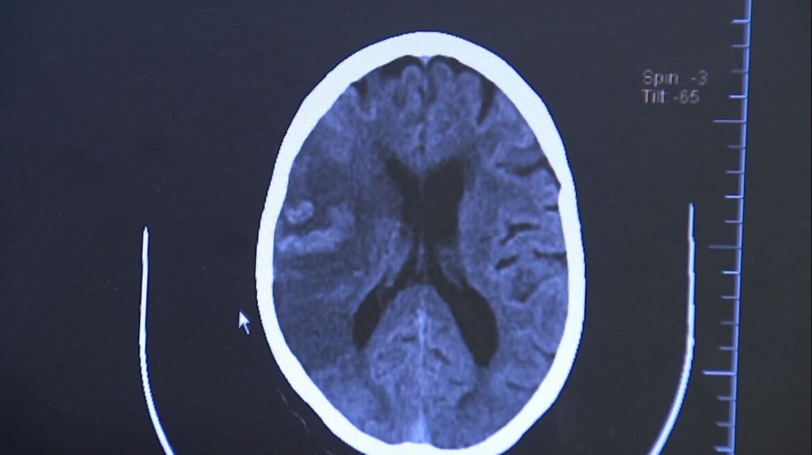 avc-tira-a-vida-de-um-brasileiro-a-cada-seis-minutos;-80%-dos-casos-poderiam-ser-evitados avc-tira-a-vida-de-um-brasileiro-a-cada-seis-minutos;-80%-dos-casos-poderiam-ser-evitados