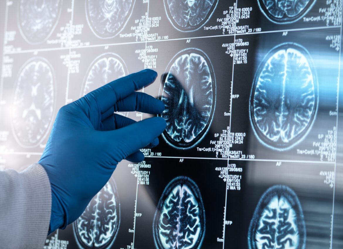 inflamacao-no-cerebro-pode-ser-peca-chave-na-progressao-do-alzheimer,-revela-estudo-liderado-por-brasileiros