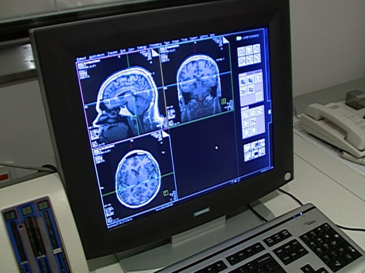 avc,-alzheimer-e-enxaqueca:-por-que-oms-emitiu-alerta-sobre-essas-doencas-e-condicoes-neurologicas?