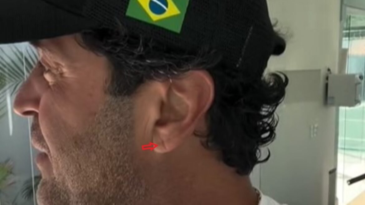 dobra-na-orelha:-apos-morte-de-influenciador,-medicos-explicam-qual-a-relacao-do-‘sinal-de-frank’-com-risco-de-infarto