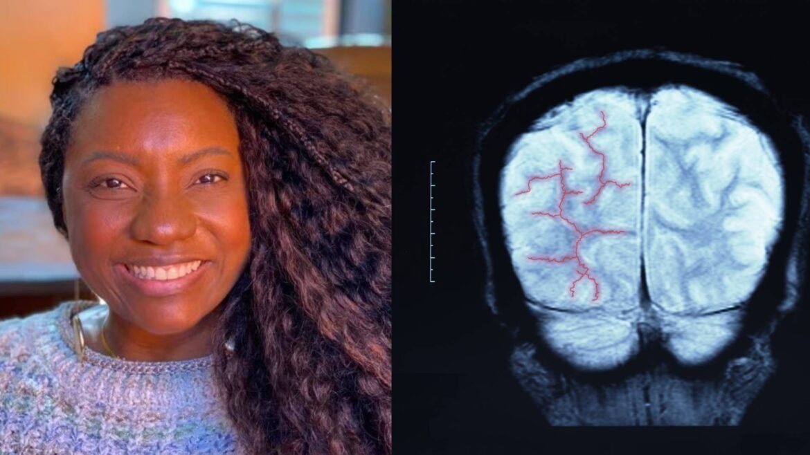 aneurisma-cerebral:-entenda-o-que-causou-o-coma-da-sambista-adriana-araujo
