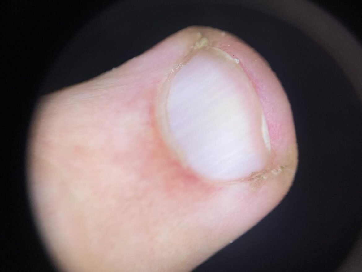 alteracoes-nas-unhas-podem-indicar-problemas-de-circulacao?-veja-mitos,-verdades-e-sinais-de-alerta