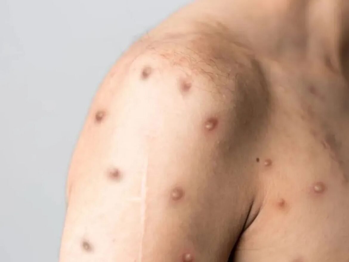 mpox-mata?-pega-pelo-ar?-beijo-transmite?-g1-responde-as-principais-buscas-do-google-sobre-a-doenca