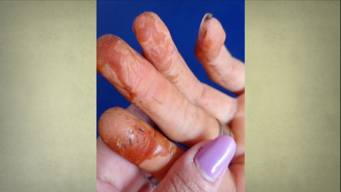 maos-queimadas-e-trabalho-infantil:-desafios-da-producao-artesanal-da-castanha-de-caju-no-rio-grande-do-norte-|-g1