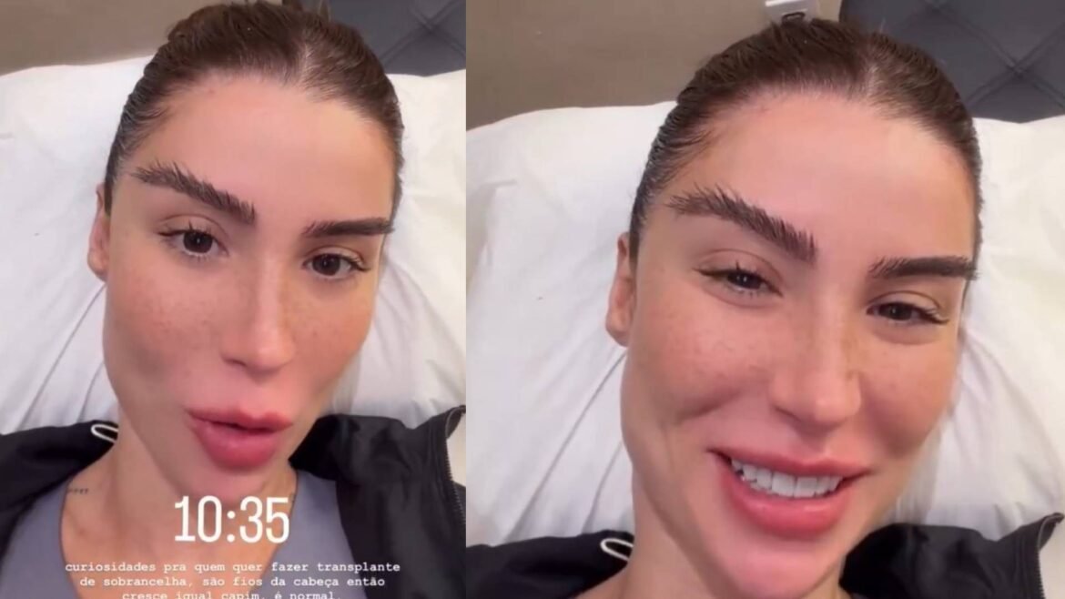 boca-rosa-mostra-transplante-de-sobrancelha:-fios-continuam-crescendo-e-resultado-nao-e-imediato;-entenda-riscos