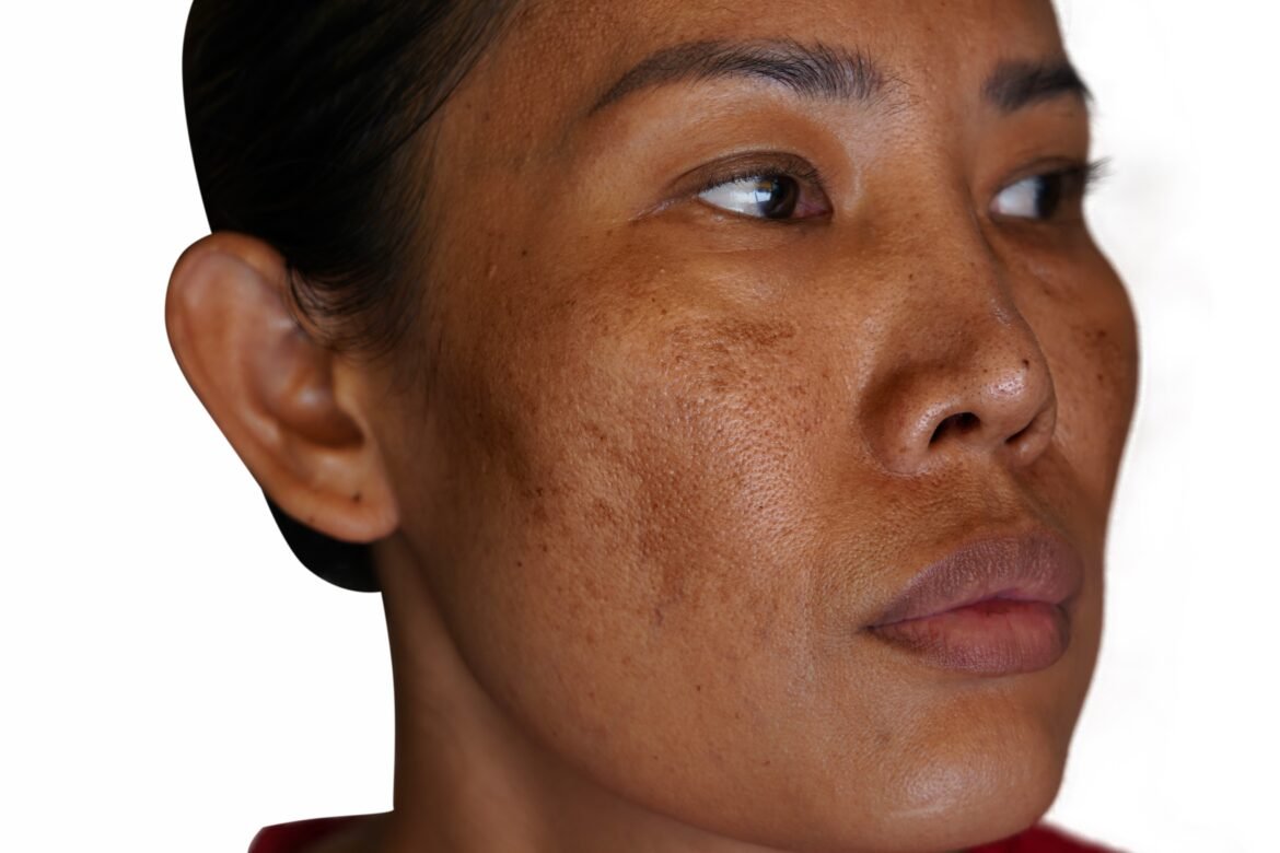manchas-em-formato-de-borboleta-na-face?-a-ciencia-mostra-como-a-dieta-ajuda-a-prevenir-e-tratar-o-melasma