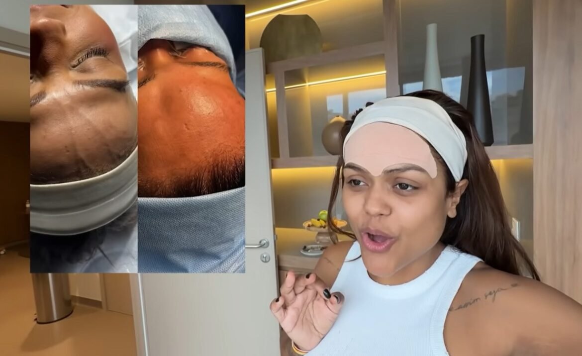 influenciadora-camila-loures-retira-‘veia-saltada’-na-testa;-procedimento-carece-de-respaldo-cientifico
