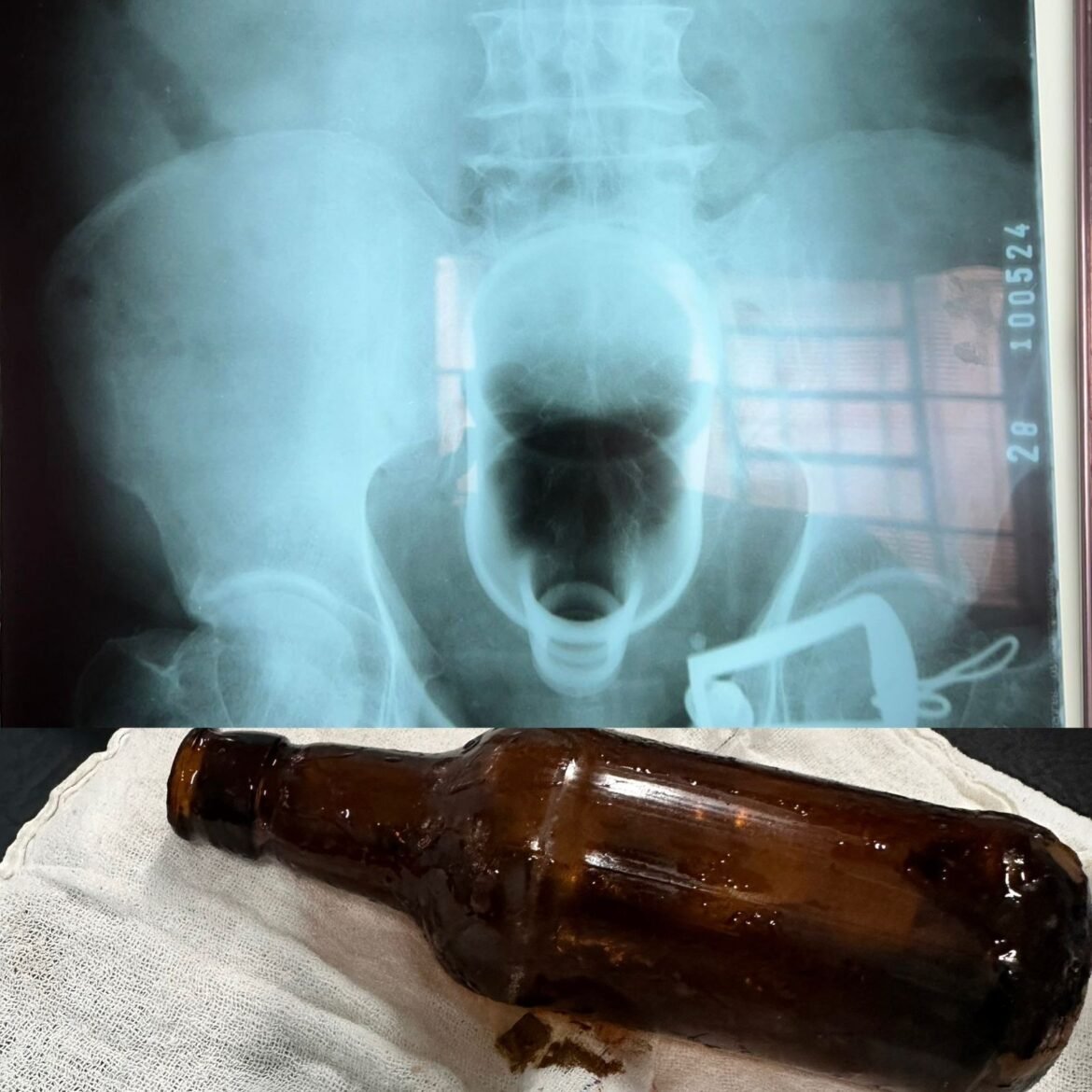 objetos-presos-no-reto-levam-pacientes-ao-centro-cirurgico;-medicos-explicam-por-que-isso-acontece-e-como-evitar