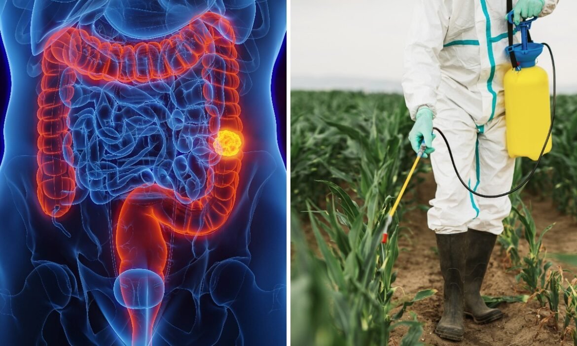estudo-liga-cancer-colorretal-em-antes-dos-50-anos-a-exposicao-a-pesticidas-e-aponta-herbicida-como-fator-de-risco