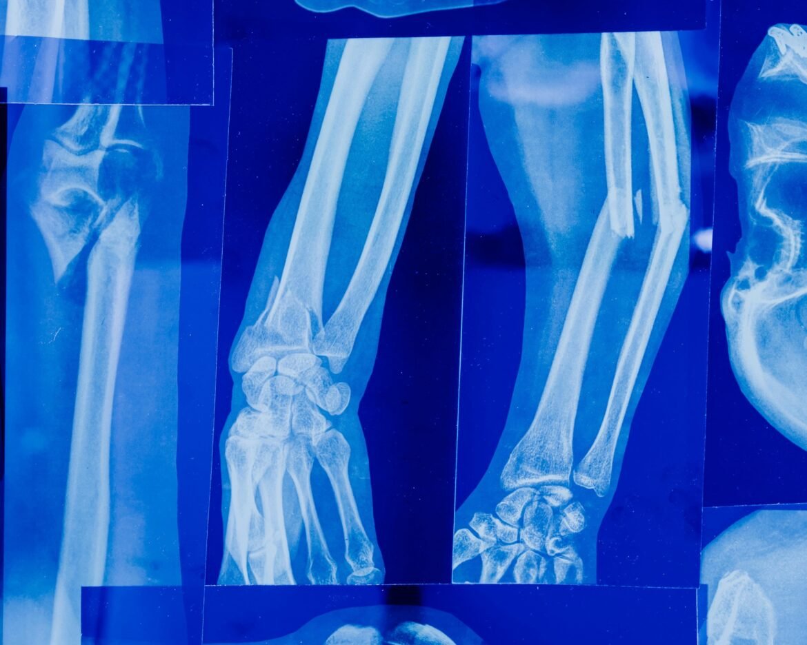 osteopenia:-por-que-essa-condicao-que-enfraquece-os-ossos-costuma-ser-descoberta-so-depois-de-uma-fratura