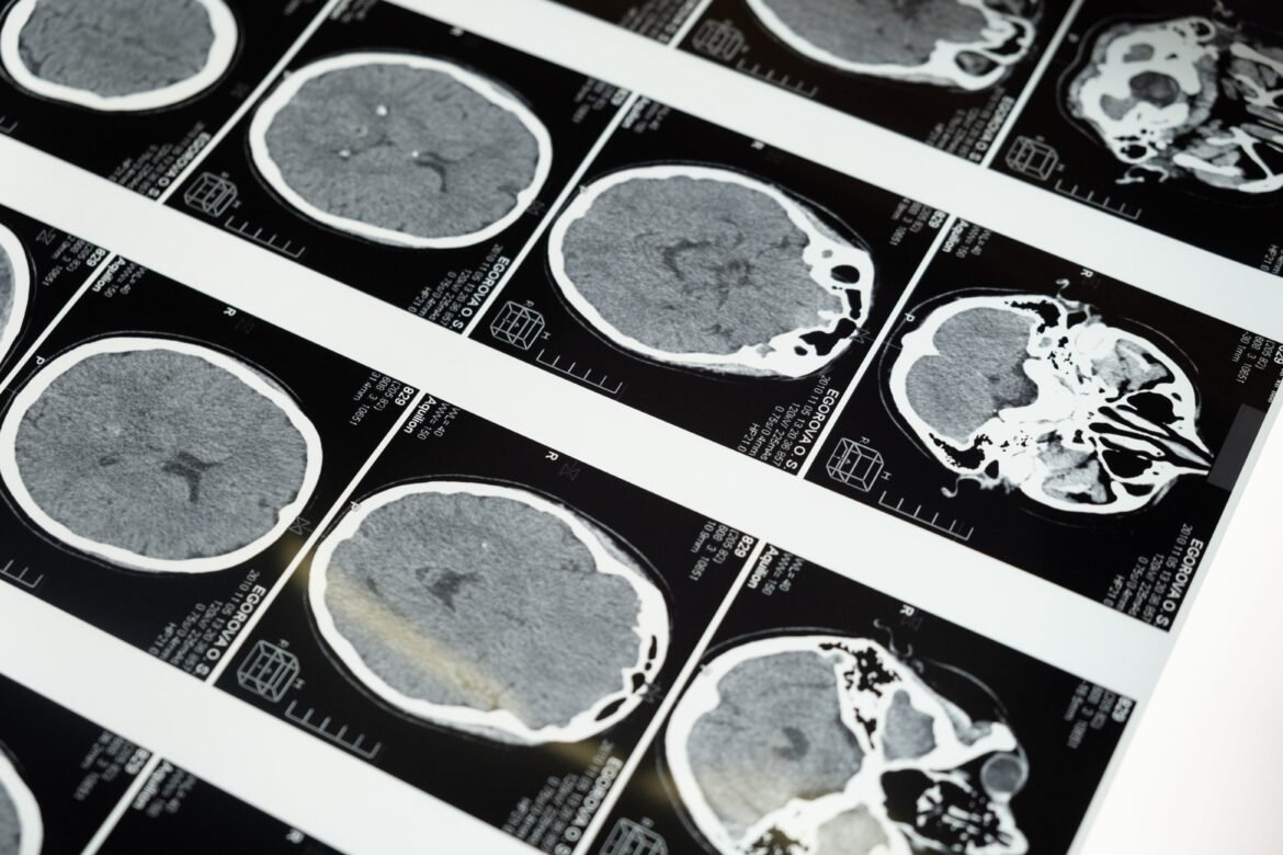 atividade-fisica-promove-‘limpeza’-do-cerebro,-diz-estudo