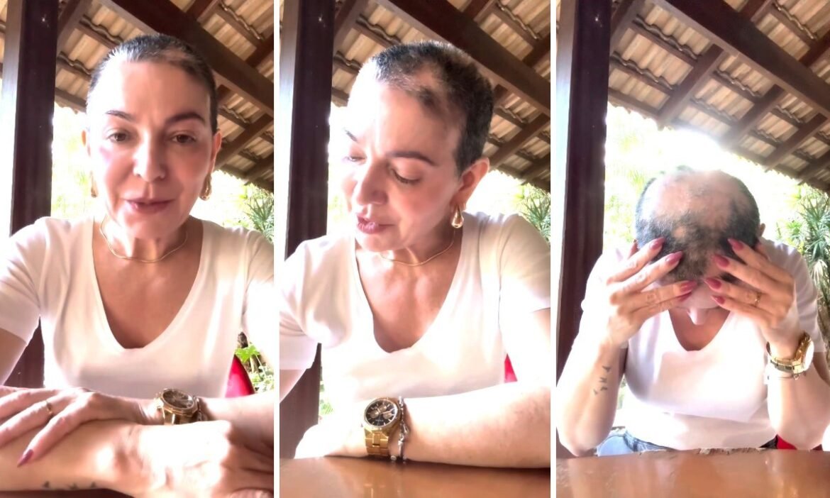 alopecia-areata:-doenca-que-fez-mae-de-lucas-lucco-perder-cabelo-tem-tratamento-de-alto-custo-e-afeta-a-saude-mental