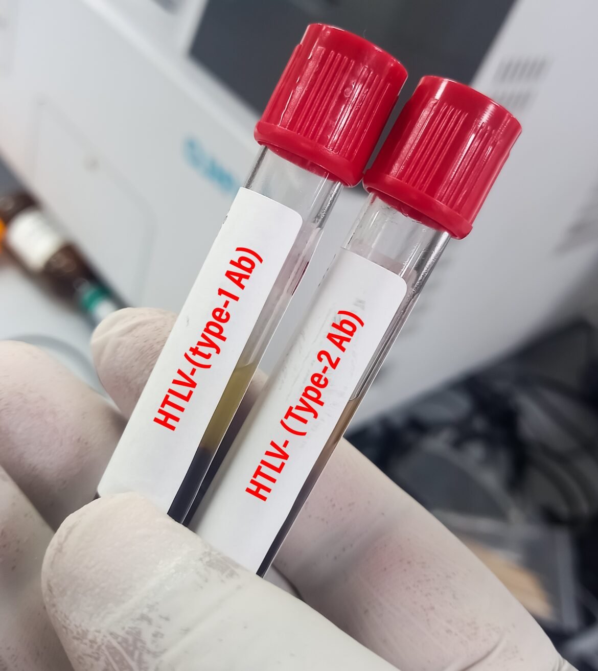 estudo-brasileiro-usa-retrovirus-htlv-1-para-investigar-avanco-da-esclerose-multipla-progressiva