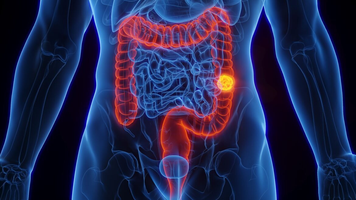 sus-inclui-teste-de-alta-tecnologia-para-rastreamento-de-cancer-colorretal