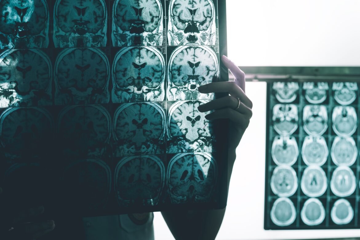 estudo-revela-que-celulas-de-defesa-do-cerebro-podem-ajudar-a-combater-o-alzheimer