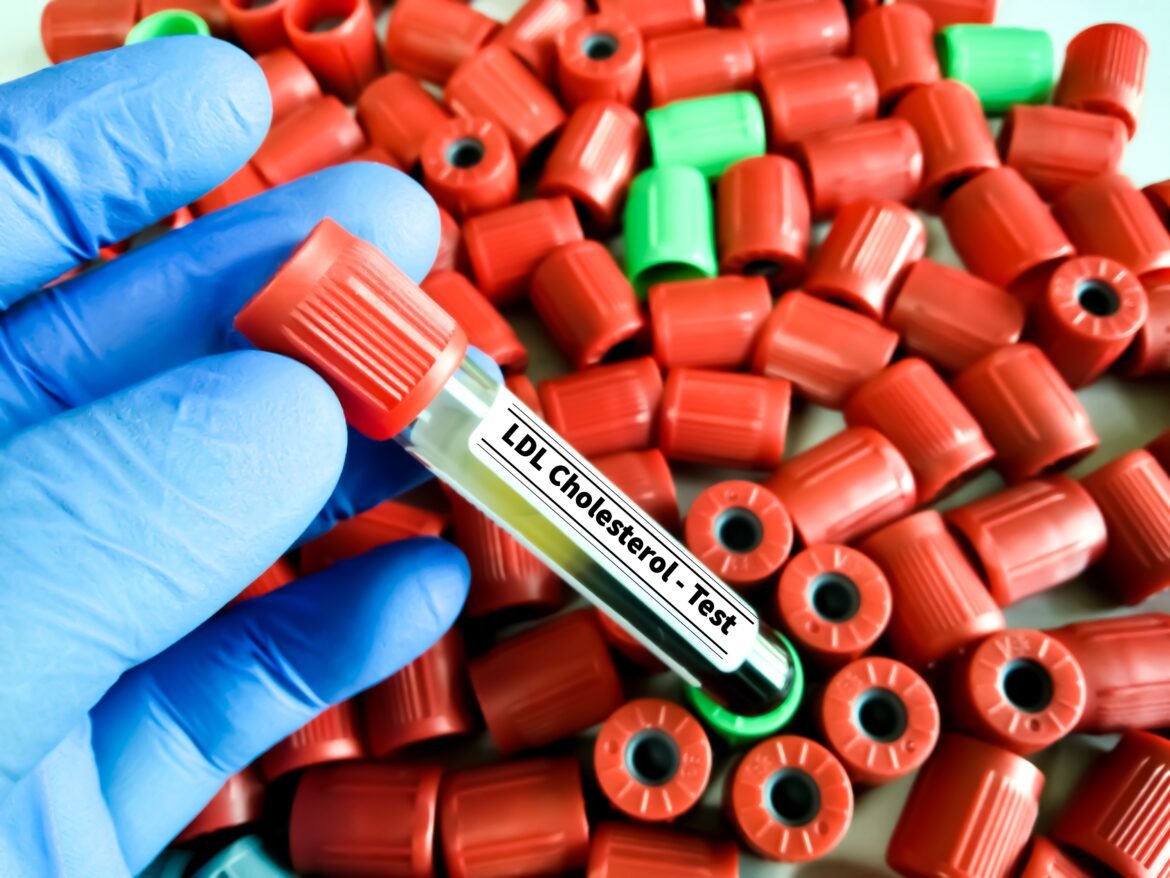 pesquisa-consegue-controlar-colesterol-alto-por-ate-um-ano-com-dose-unica-de-tratamento