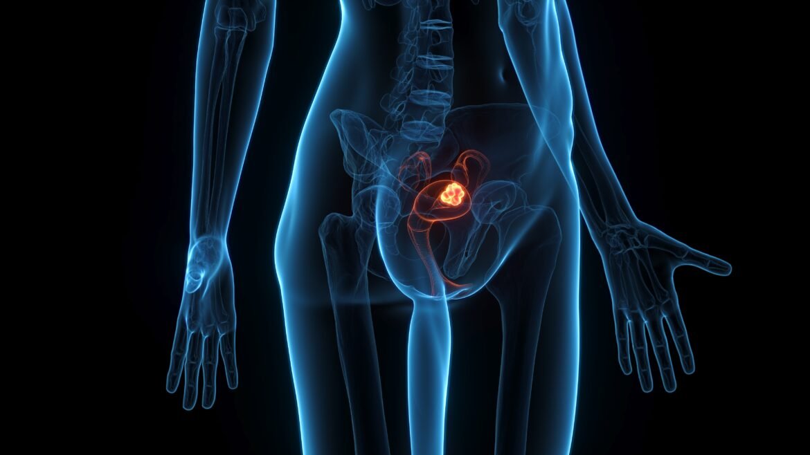 cancer-de-endometrio:-estudo-do-inca-identifica-marcador-ligado-ao-risco-de-recorrencia