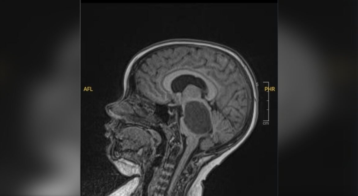novo-teste-pode-identificar-tipo-de-tumor-cerebral-em-menos-de-duas-horas-e-acelerar-diagnostico