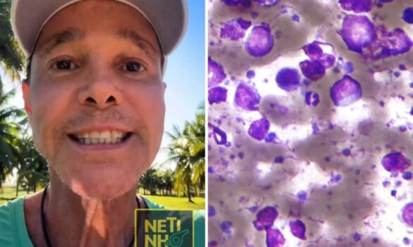 entenda-o-que-e-o-linfoma-nao-hodgkin,-cancer-que-levou-netinho-a-ser-internado-em-salvador