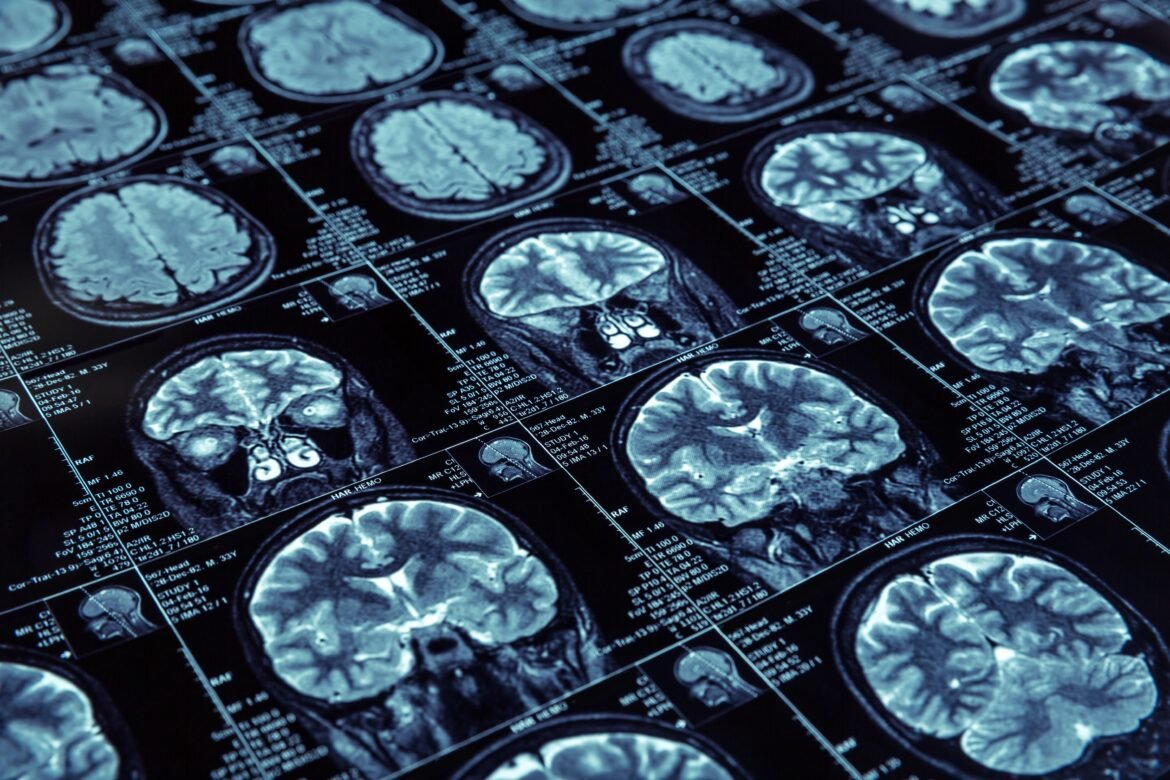 covid-longa-pode-estar-ligada-a-alteracoes-no-sistema-de-dopamina-do-cerebro,-aponta-estudo