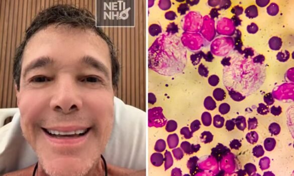 linfoma-nao-hodgkin:-cancer-que-atingiu-netinho-deve-ter-12,5-mil-novos-casos-anuais-no-brasil