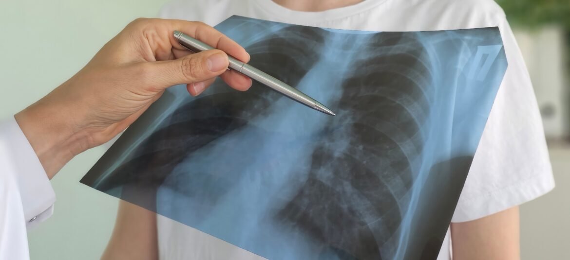 cancer-de-pulmao-do-papa-leao-xiv-alerta-para-numero-crescente-de-nao-fumantes-diagnosticados-com-a-doenca