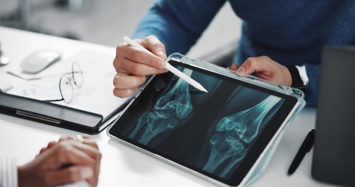 osteoporose:-entenda-os-fatores-de-risco-e-saiba-como-prevenir-a-doenca-que-enfraquece-os-ossos