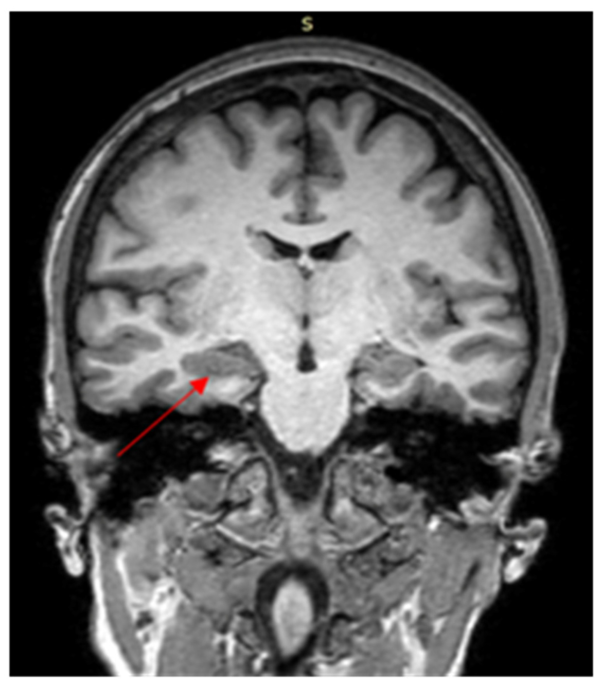 convulsoes-so-durante-a-menstruacao-levam-medicos-a-suspeitar-de-endometriose-no-cerebro-de-paciente