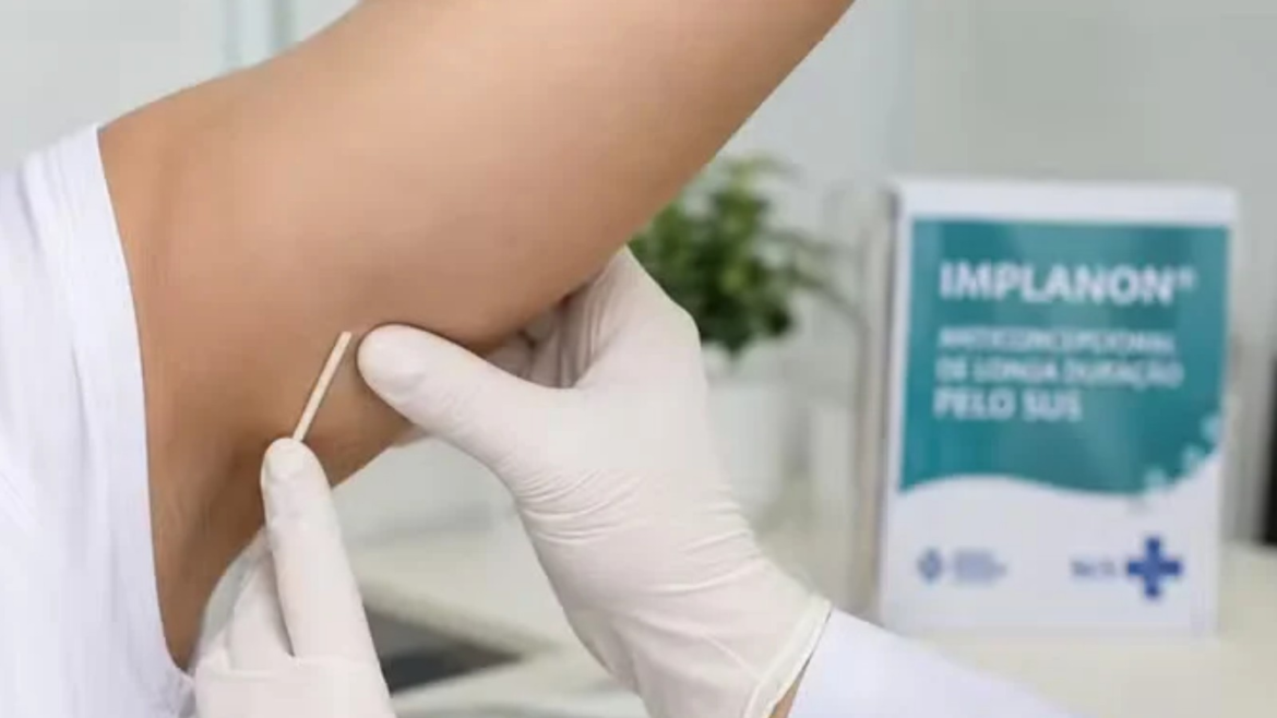 anvisa-amplia-para-cinco-anos-validade-do-implante-contraceptivo;-dispositivo-e-distribuido-no-sus