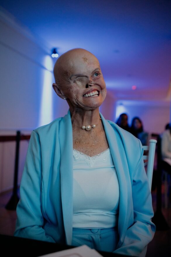 mulher-com-sindrome-genetica-rara-ja-teve-73-canceres-de-pele-e-espera-cirurgia-para-reconstruir-o-nariz